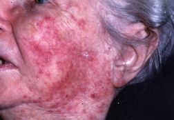 Rosacea