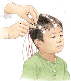 Under en EEG, är elektroder placeras på ditt barns hårbotten så kan registreras den elektriska aktiviteten i hjärnan.
