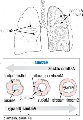Astma: en reversibel sjukdom