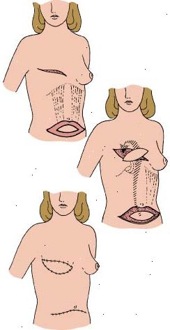 Spårvagn flik förfarande som visar hur buken vävnad används för att rekonstruera den borttagna bröstet