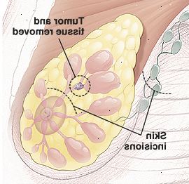Bröst anatomi med cirkel runt tumör i kanal visar vävnad tas bort. Det finns streckade linjer ovanför bröstvårtan och i armhålan för att visa små böjda snitt platser.