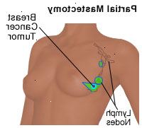 Illustration av en partiell mastektomi