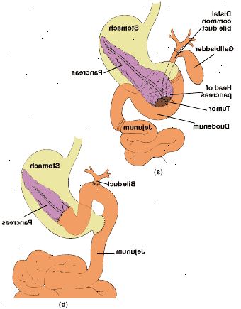 Pylorus-bevara pancreaticoduodenectomy: anatomi opererande området (a) och kopplas mag-tarmkanalen med end-to-end pancreaticojejunostomy (b).